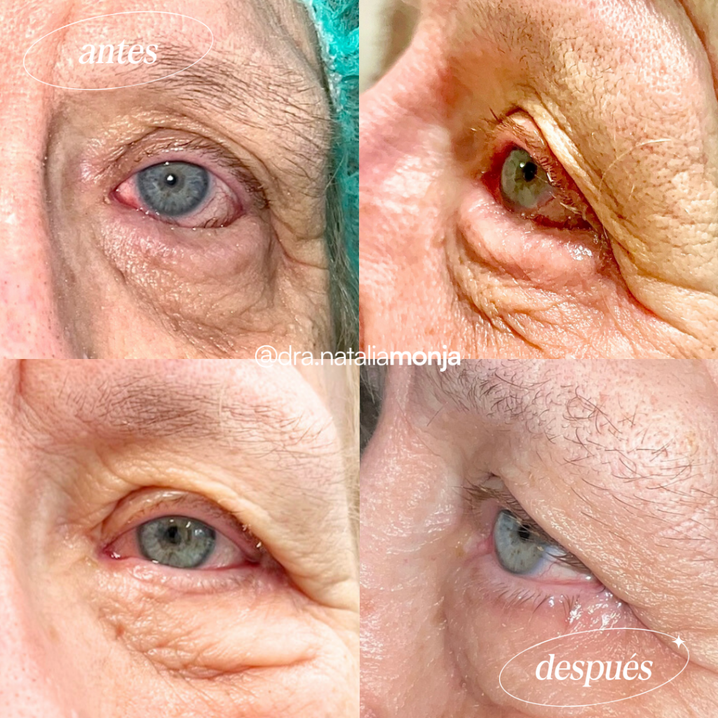 Antes y después de cirugía de entropión en mujer anciana blanca.