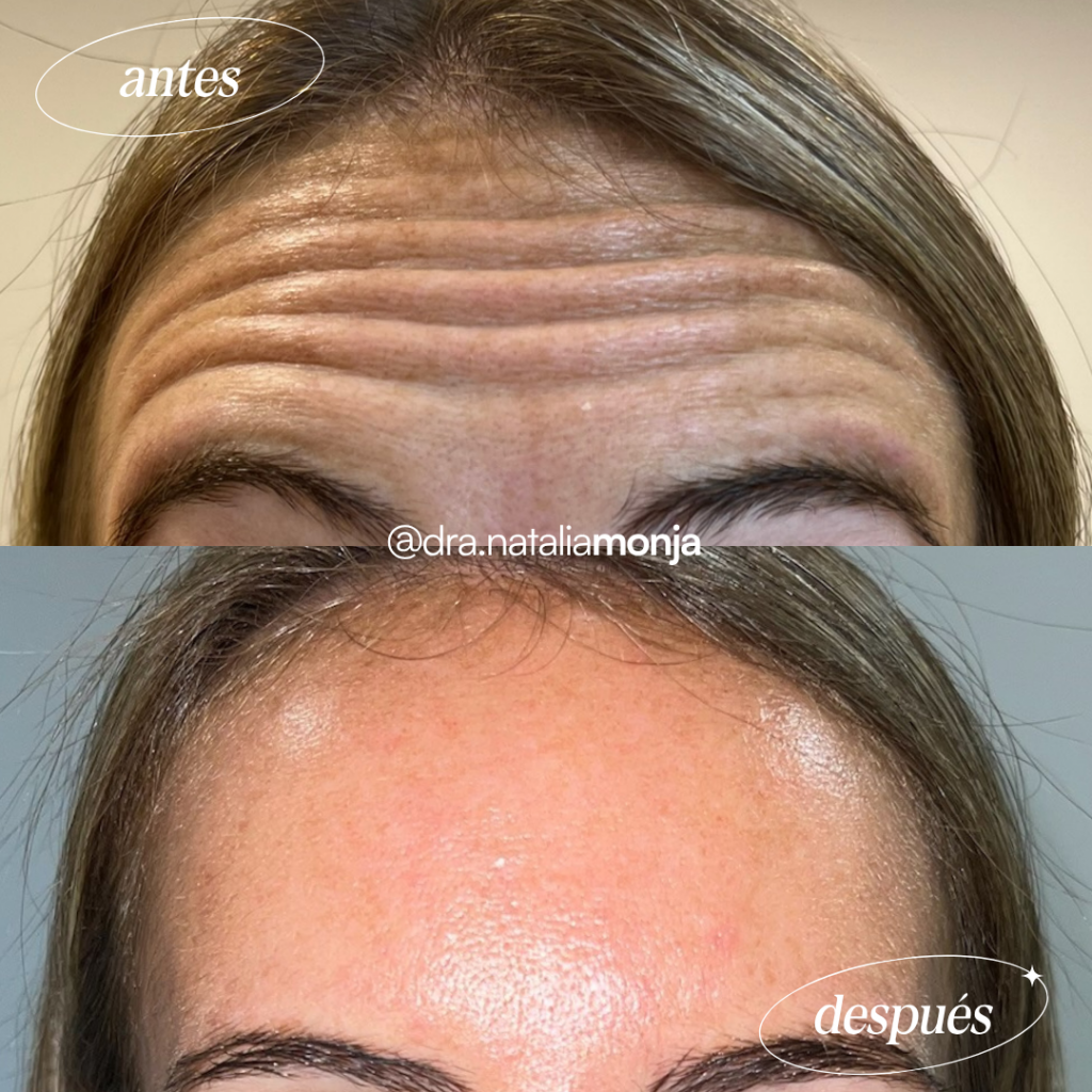 Antes y después neuromoduladores en tercio superior. La paciente hace el gesto de levantar las cejas.