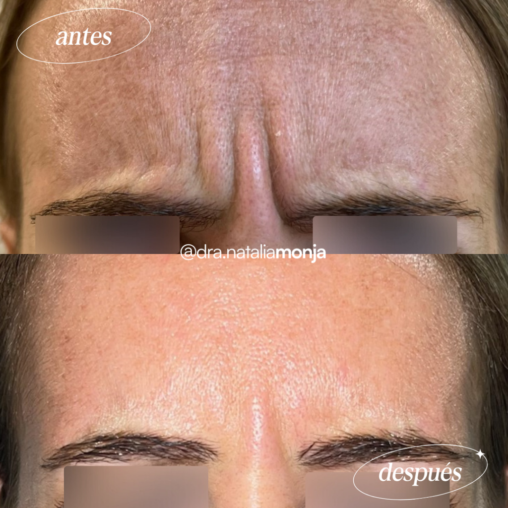 Antes y después neuromoduladores en tercio superior. La paciente hace el gesto de fruncir el ceño.
