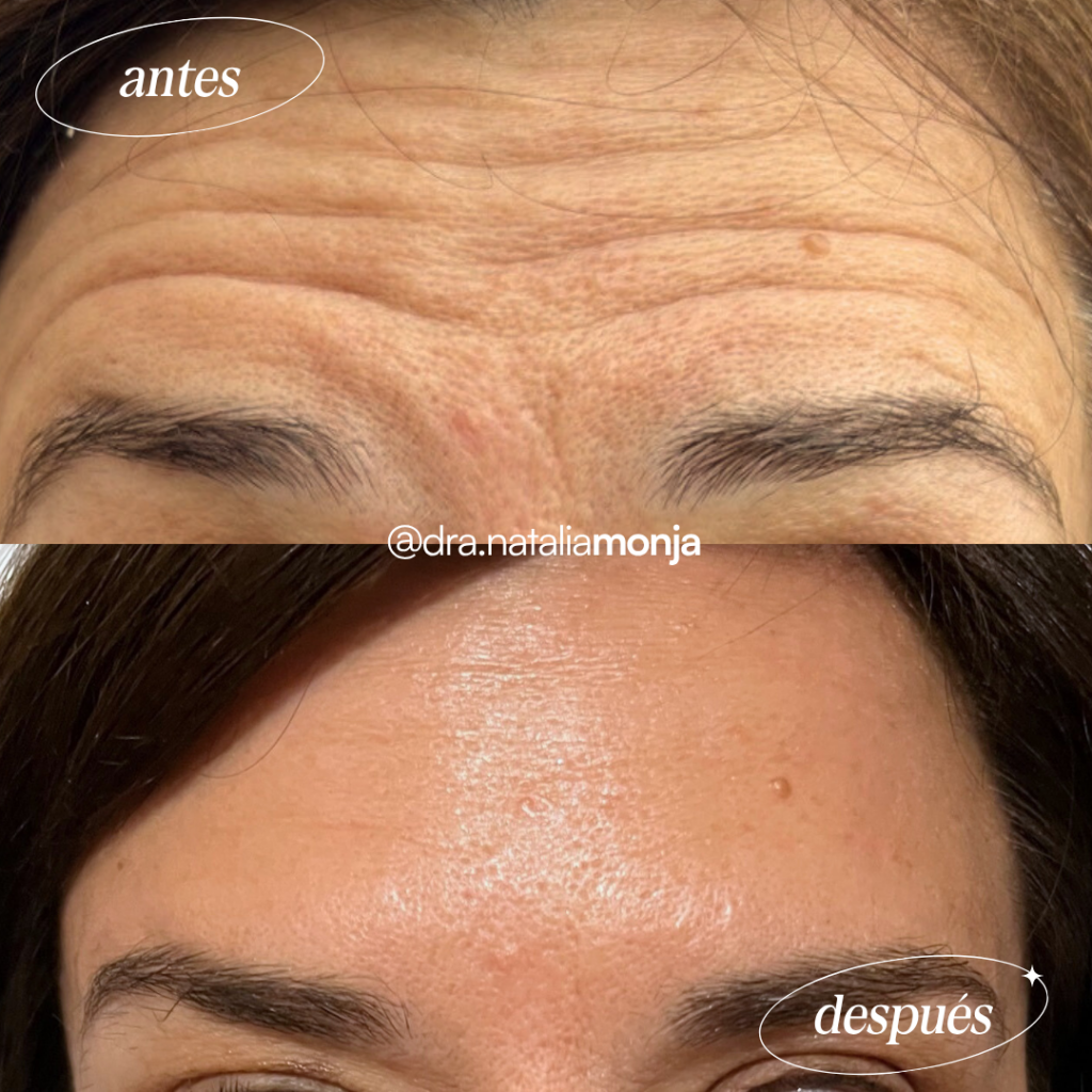 Antes y después neuromoduladores en tercio superior. La paciente hace el gesto de levantar las cejas.