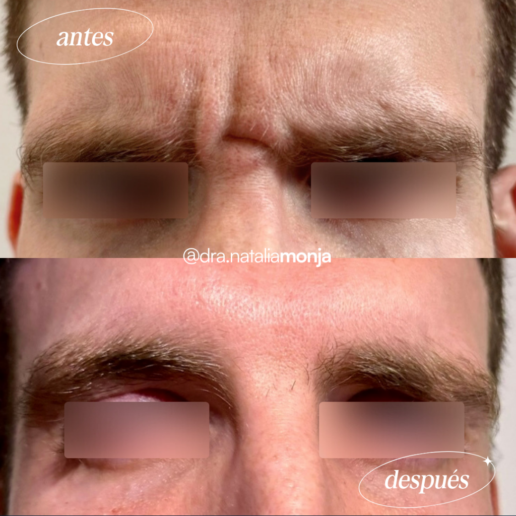 Antes y después neuromoduladores en tercio superior. El paciente hace el gesto de fruncir el ceño.