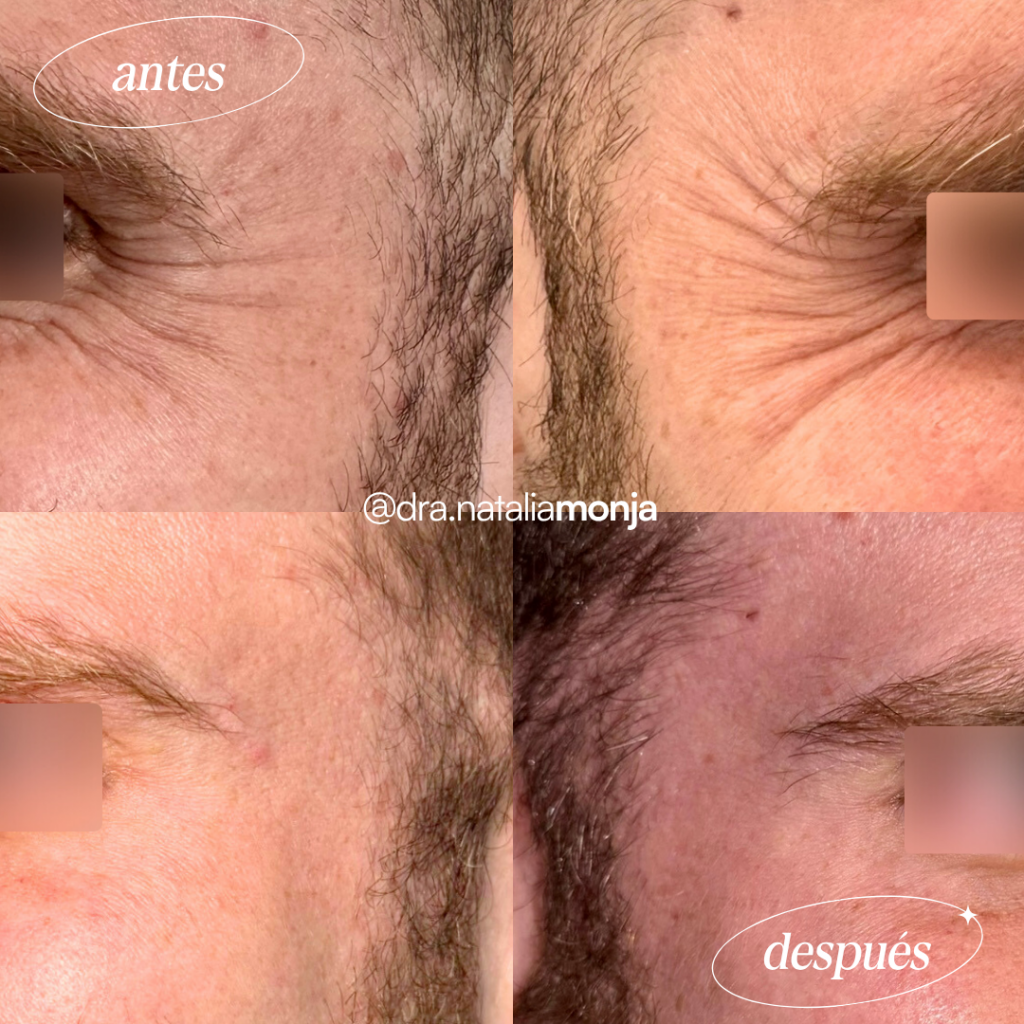 Antes y después neuromoduladores en tercio superior. El paciente hace el gesto sonreir, enfocando en las patas de gallo.