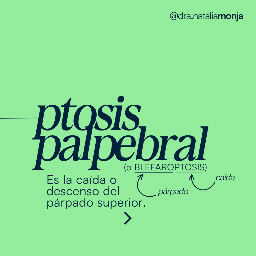 infografia con definición de ptosis palpebral