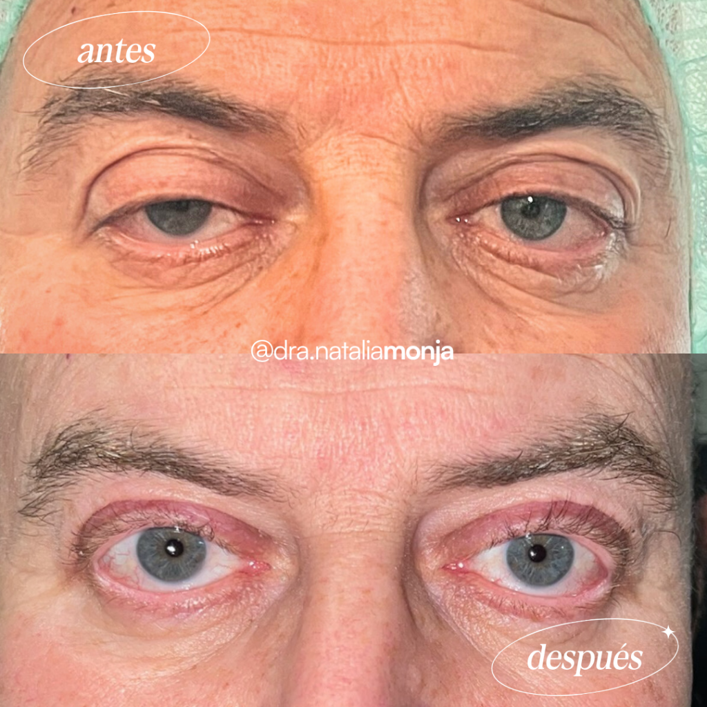 Antes y después de operación de ptosis palpebral en varón.